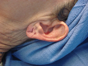 earlobetears